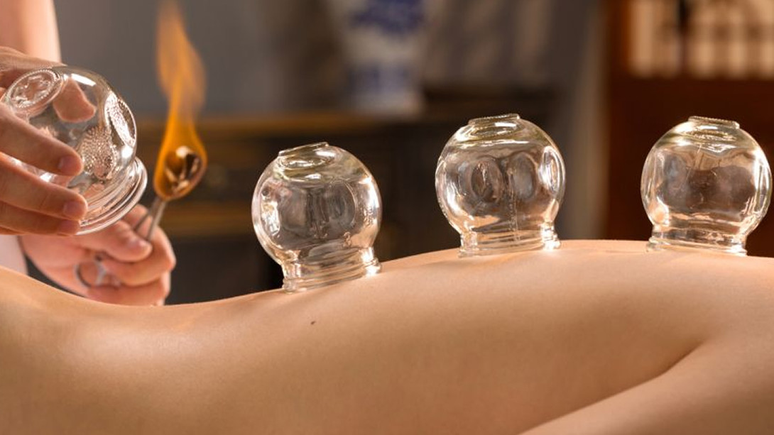 What is Cupping Therapy? All You Need to Know About It